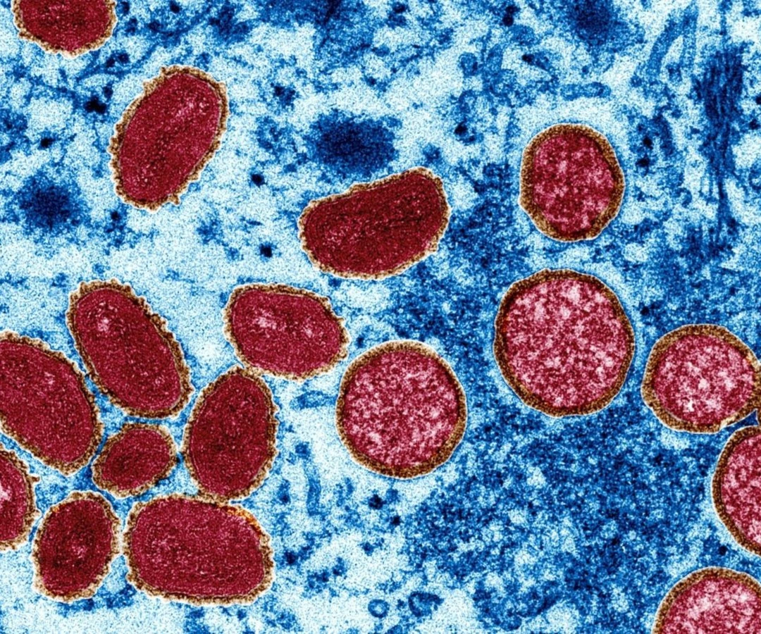 Chile confirma segunda muerte por viruela símica Chile confirma segunda muerte por viruela símica