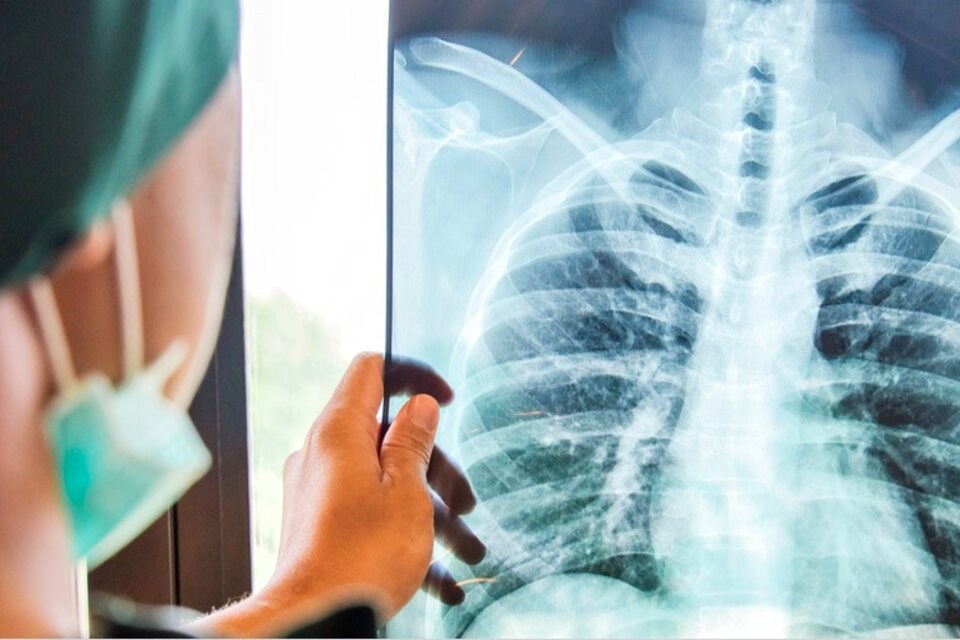 Incremento de casos de tuberculosis. Foto: Redes.